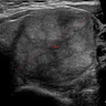 5 cm nodule on ultrasound