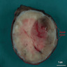 Thyroid mass, 6.2 cm