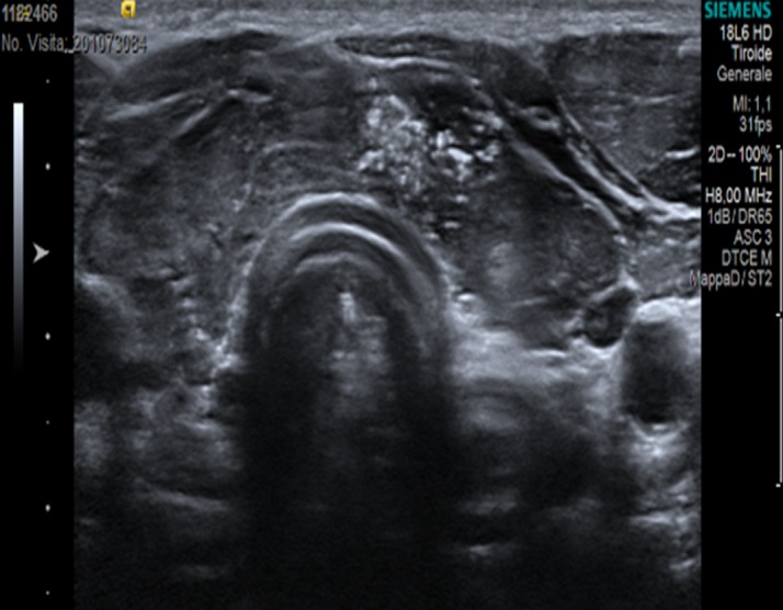 Ultrasonographic / cytologic features of S / T PTC