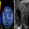 FDG PET and ultrasound