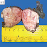 Total thyroidectomy specimen