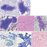 Trabeculae and solid nests of tumor cells