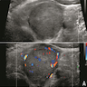 Ultrasonographic / cytologic features of S / T PTC