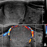 Ultrasonographic / cytologic features of S / T PTC