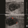 Ultrasonographic / cytologic features of S / T PTC