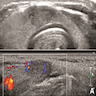 Ultrasonographic / cytologic features of S / T PTC