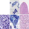 Syncytial, tissue fragment pattern