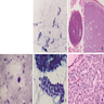 Trabecular pattern