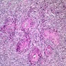 Pathology Outlines - Low grade endometrial stromal sarcoma