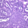 Pathology Outlines - Endometrial metaplasia