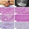 Vulvar angiomyofibroblastoma: MRI