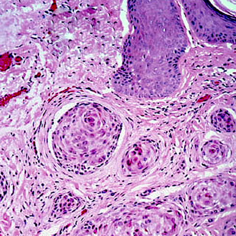 Pathology Outlines - Microcystic adnexal carcinoma