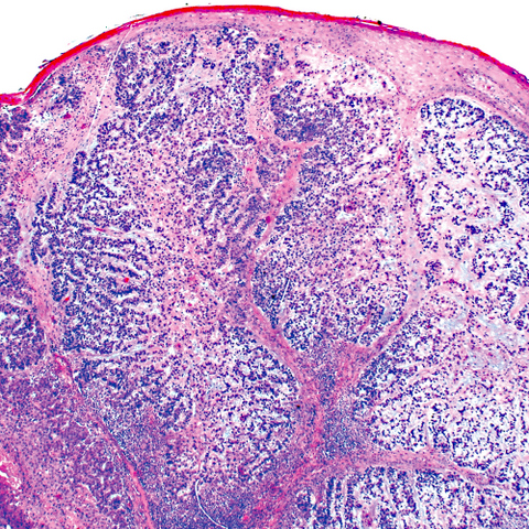 Pathology Outlines - Sebaceous carcinoma